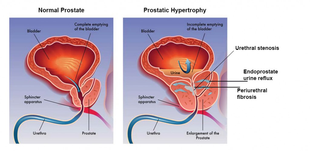 What happens in the body when you get prostatitis?