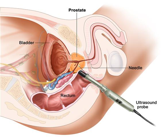 Prostatitis Symptoms