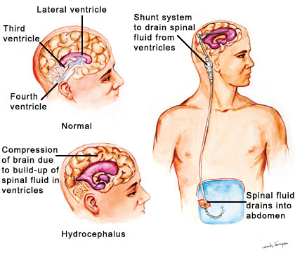 Brain Tumors