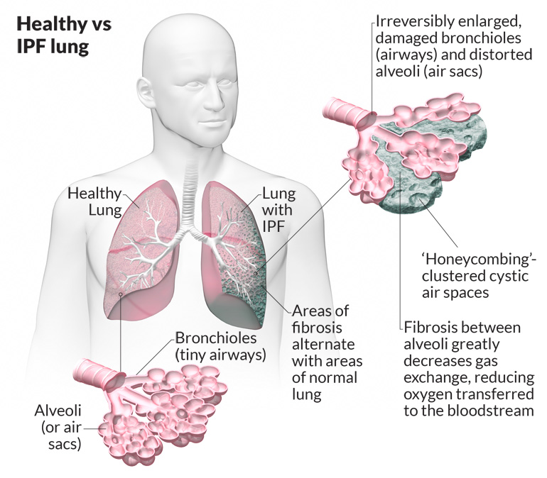 Sildenafil Drug May Help Improve Exercise Ability in Pulmonary Fibrosis ...