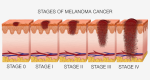 Melanoma