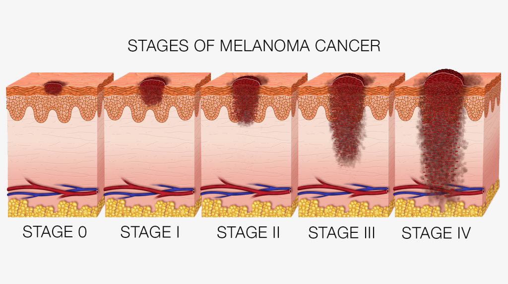 Melanoma