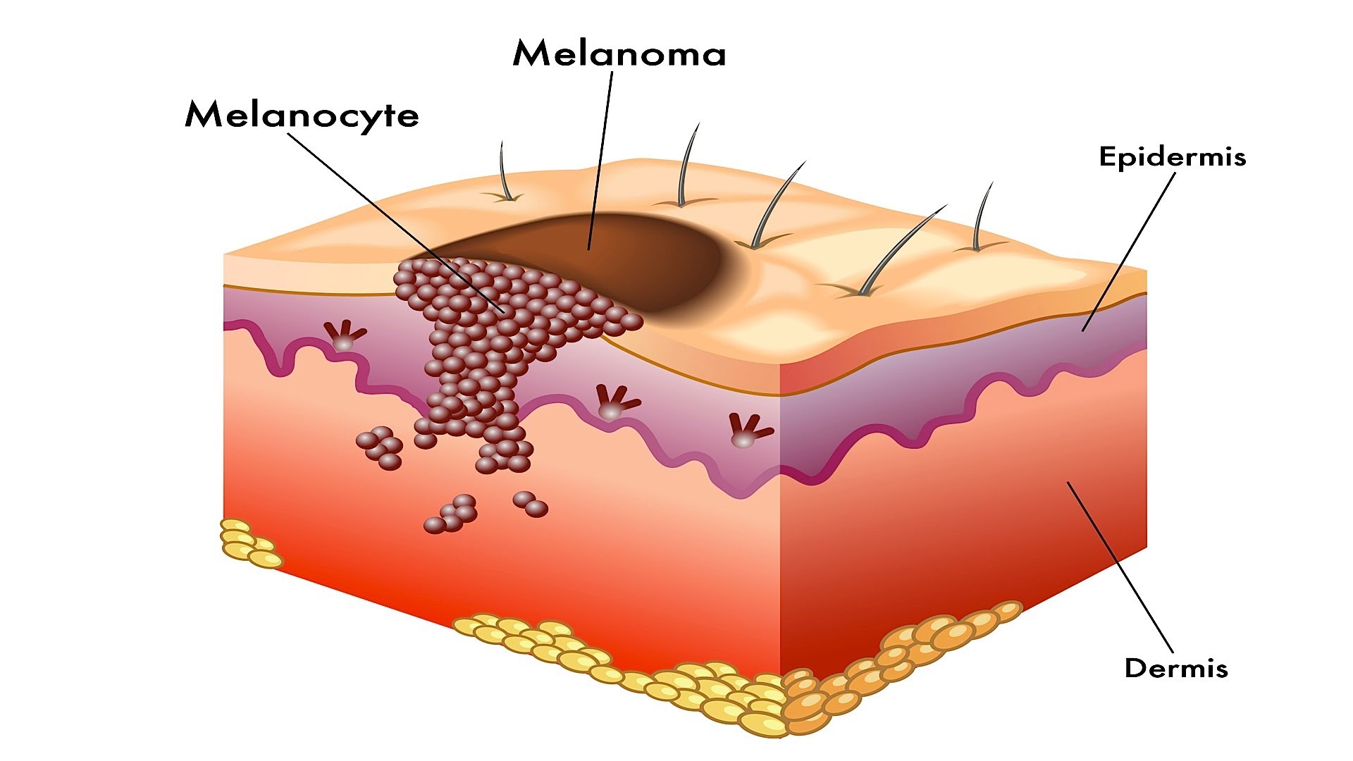 Melanoma_viagra