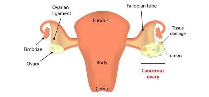 Ovarian cancer