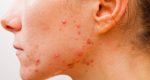 Acne Causes, Symptoms, Treatments At Canadian Health&Care Mall