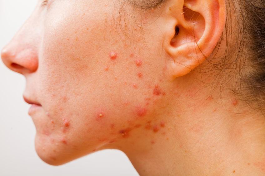 Acne Causes, Symptoms, Treatments At Canadian Health&Care Mall